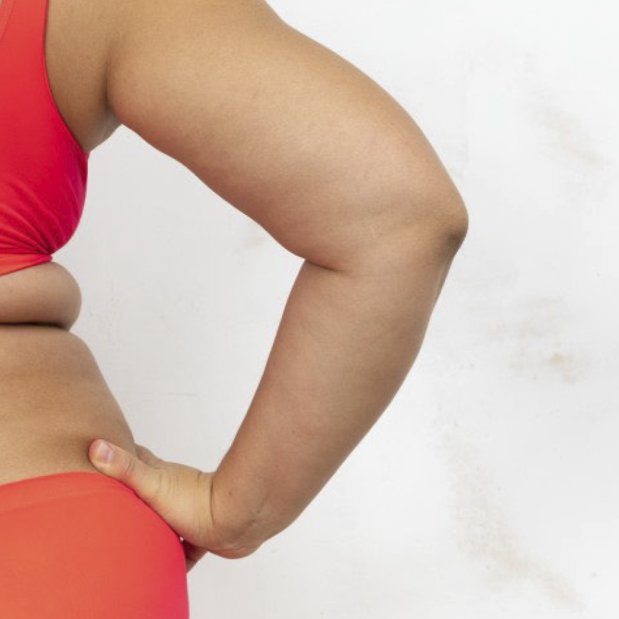 cirugía, perdida, peso, arm, lift, braquiplastia