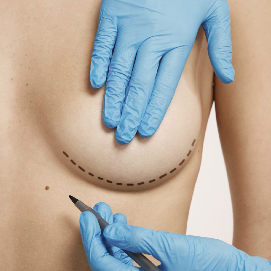 cirugía, mamaria, mamoplastia, reducción, mama