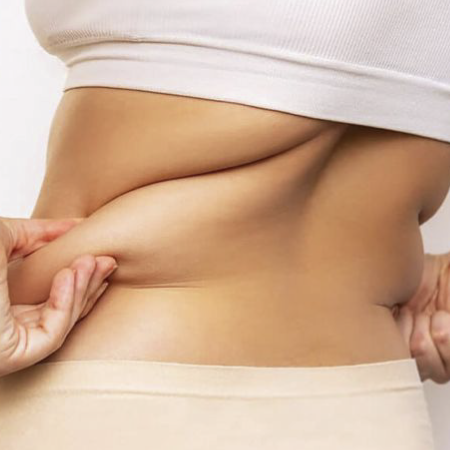 cirugía, peso, abdominoplastia